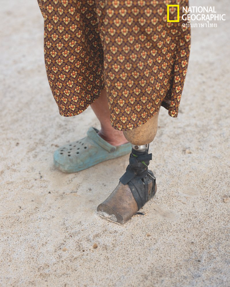 ทุ่นระเบิด, เหยื่อทุ่นระเบิด, ขาเทียม