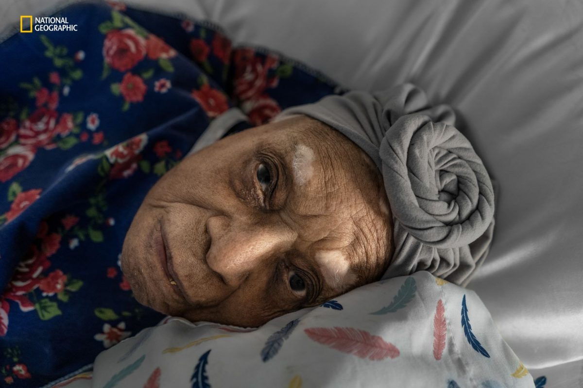 สมองเสื่อม, อัลไซเมอร์